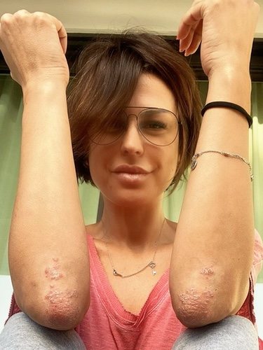 Raquel Perera mostrando los efectos de la psoriasis / Instagram