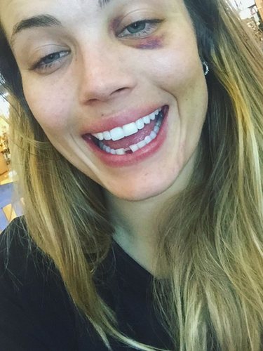 Alyson Eckmann posa sin diente y con el ojo morado en su Instagram /Fuente: Instagram