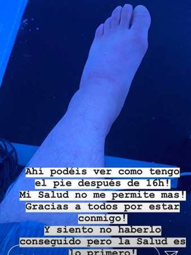 Kiko Rivera muestra su pie hinchado | Instagram