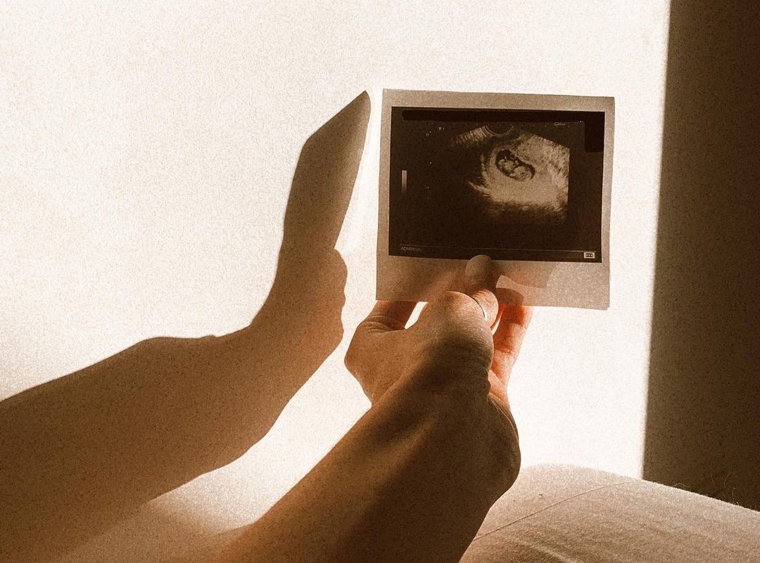 La ecografía del bebé de Javier Tudela y Marina Romero/ Foto: Instagram