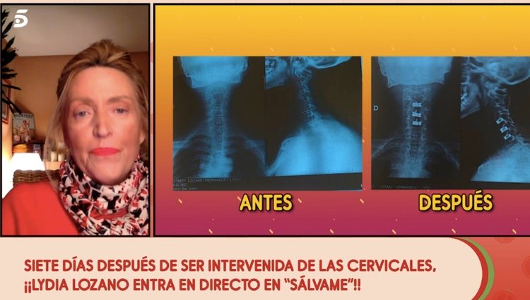 Lydia Lozano muestra el antes y el después en radiografías | Foto: telecinco.es