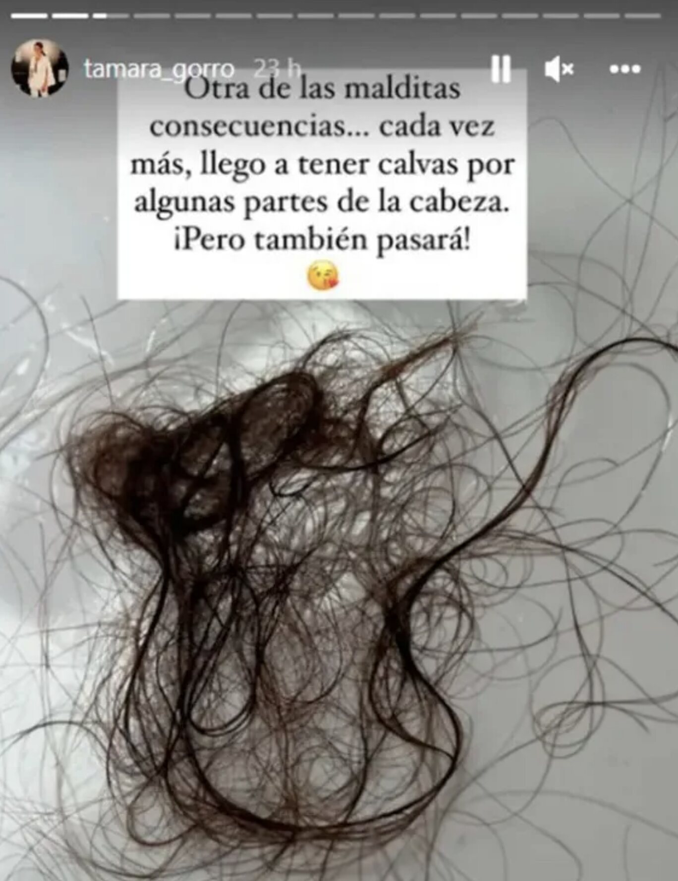 Tamara Gorro enseña el cabello que ha perdido/ Foto: Instagram