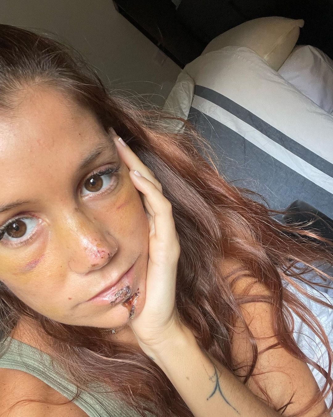 Miri enseña la evolución de su rostro tras su accidente/ Foto: Instagram