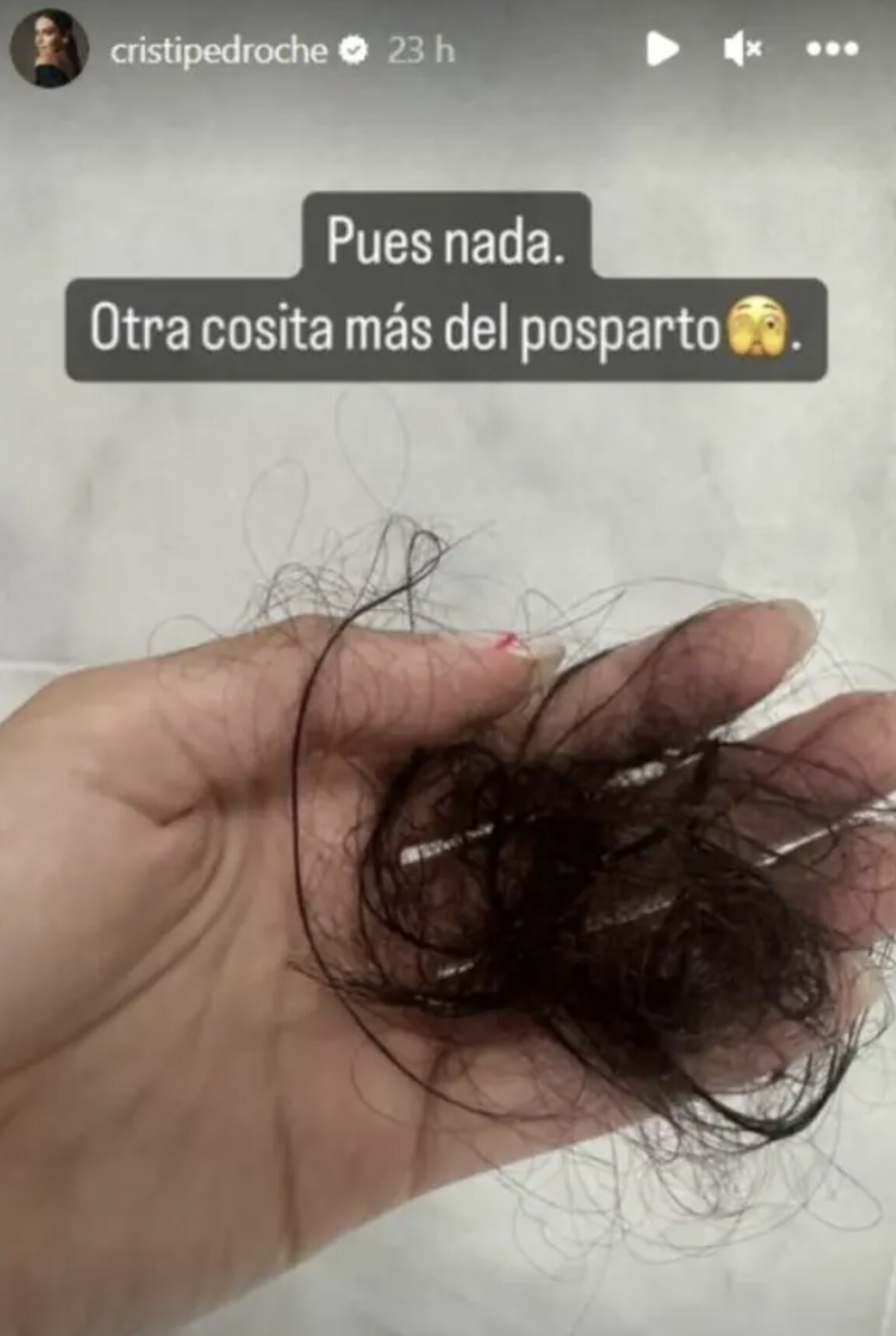 Cristina Pedroche enseña su pérdida de cabello/ Foto: Instagram