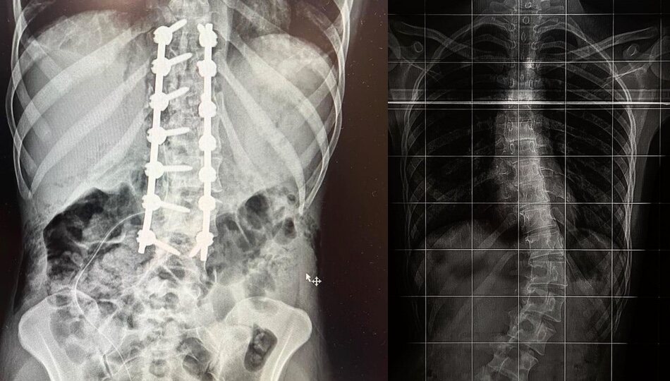 La espalda de Milena Smit tras la operación y antes de la intervención/ Foto: Instagram