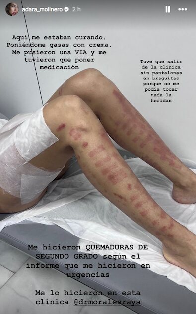 Adara Molinero enseña las quemaduras de sus piernas/ Foto: Instagram