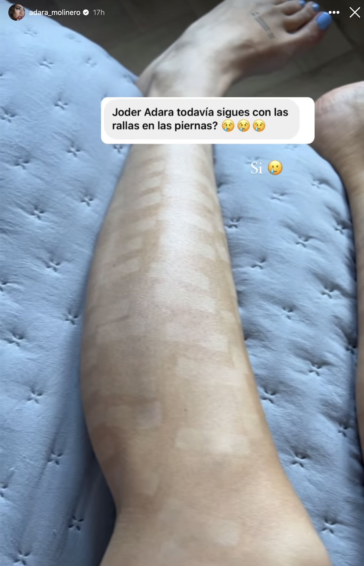 Adara Molinero enseña las quemaduras de sus piernas | Foto: Instagram