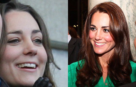 El cambio en la dentadura de Kate Middleton desde 2007 hasta 2011