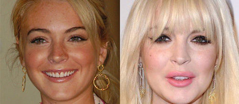 Lindsay Lohan, antes y después de pasar por quirófano