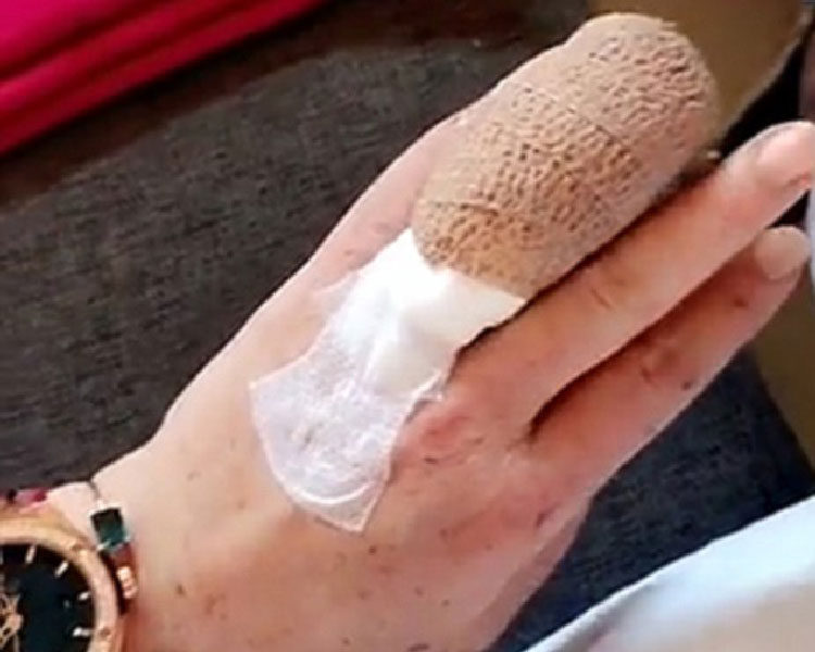Imagen del dedo dañado de Lindsay Lohan