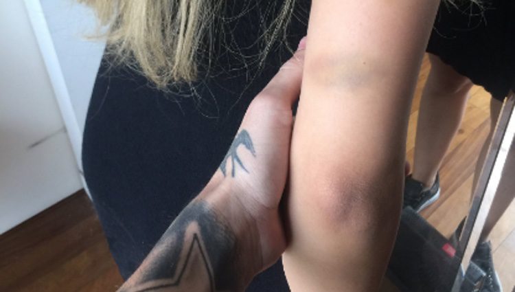 Charlotte Caniggia con un moratón en el brazo/ Fuente: Twitter Alex Caniggia