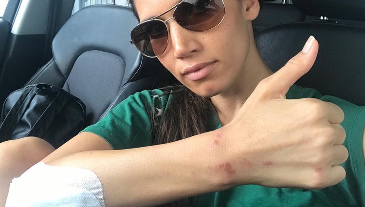 India Martínez muestra sus heridas tras un atraco