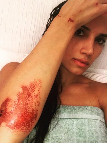 India Martínez muestra sus heridas tras ser atracada