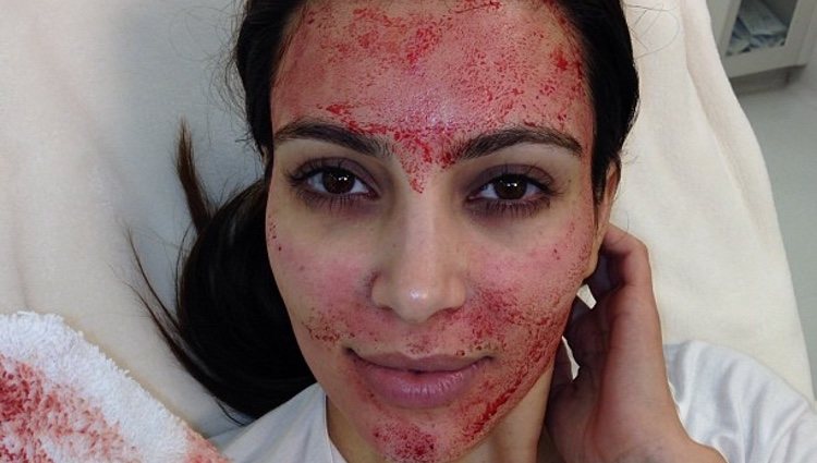 Kim Kardashian mostrando el 'Vampire facial' en Instagram