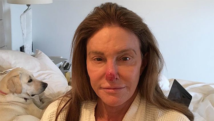Caitlyn Jenner con una herida en su nariz tras ser intervenida por cáncer de piel / Fuente: Instagram