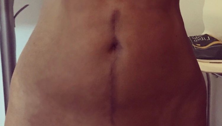 Marisa Jara enseña su cicatriz en el abdomen/ Foto: Instagram
