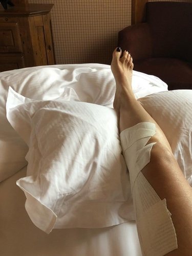 La pierna lesionada de Eva González/ Foto: Instagram
