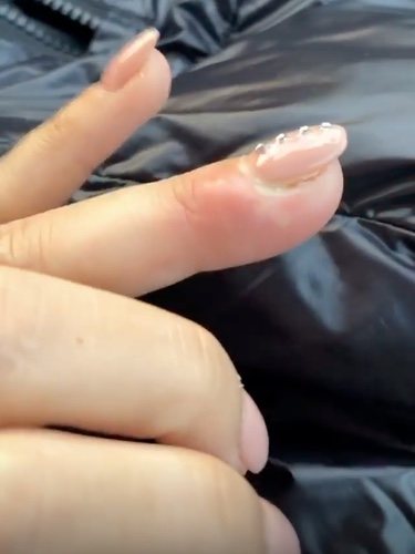 El dedo infectado de Tamara Gorro/ Foto: Instagram