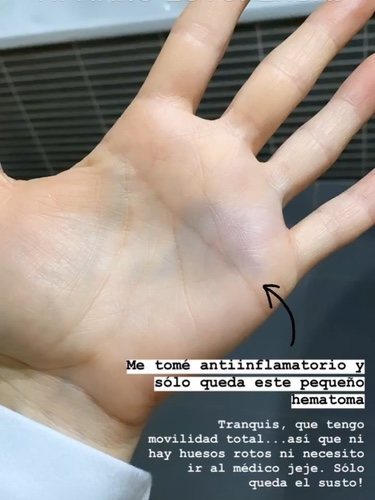 La mano de Verdeliss tras el accidente/ Foto: Instagram
