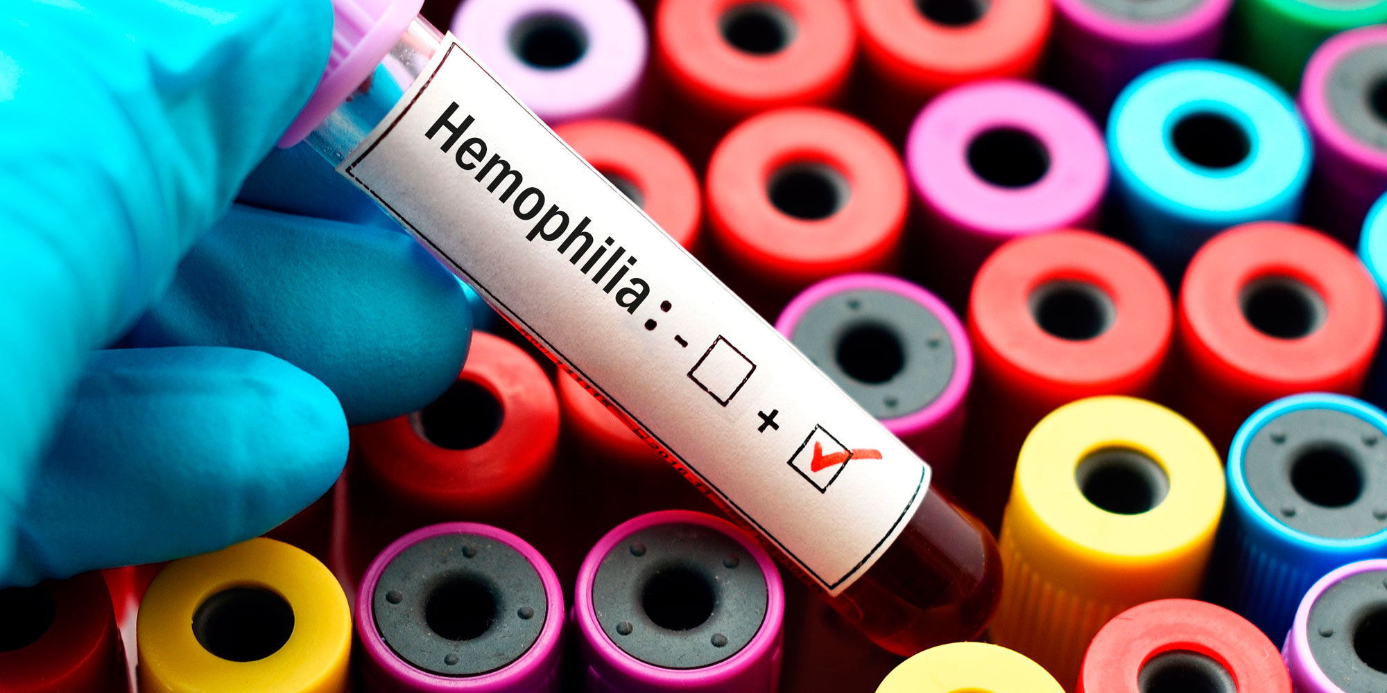 Día Mundial de la Hemofilia: Famosos que padecen este trastorno