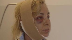Las imágenes más impactantes y bochornosas de Carmen Borrego tras su última operación estética
