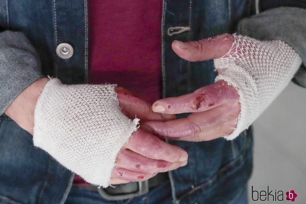 Las heridas de las manos de Manu Tenorio tras su accidente doméstico