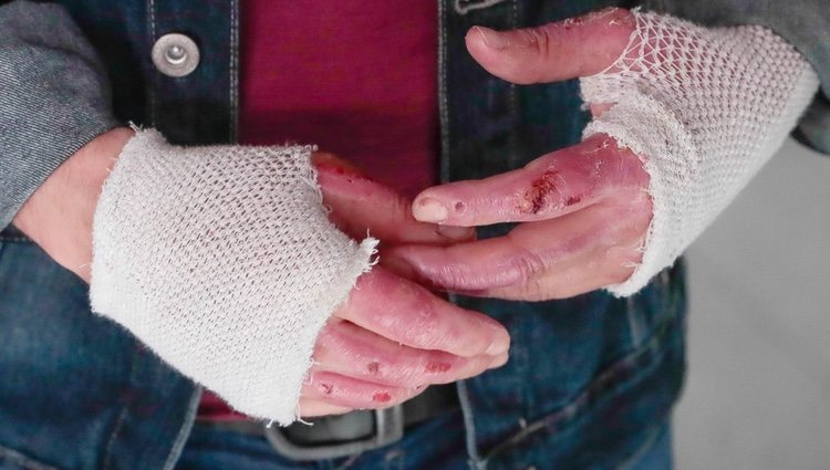 Las heridas de las manos de Manu Tenorio tras su accidente doméstico