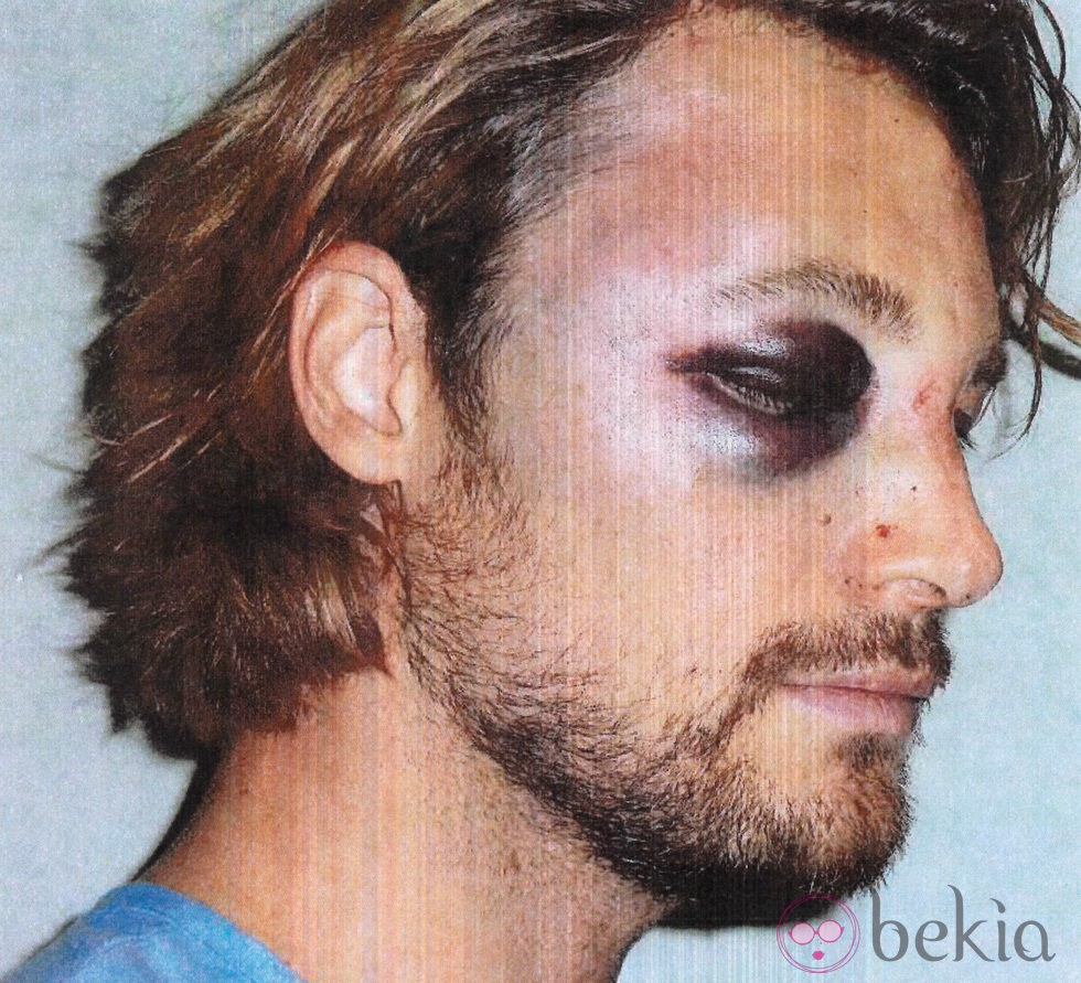 Gabriel Aubry con el ojo morado tras la pelea con Olivier Martínez