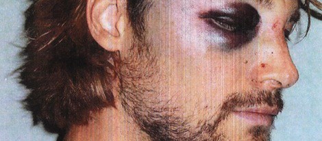 Gabriel Aubry con el ojo morado tras la pelea con Olivier Martínez