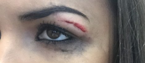 La herida de Sofía Suescun en el ojo