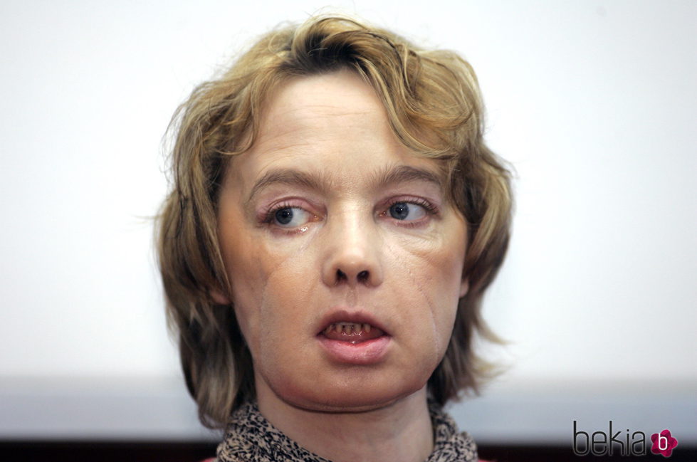 Isabelle Dinore, la mujer francesa que se sometió por primera vez a un trasplante de cara