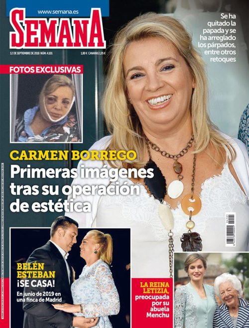 Las primeras imágenes de Carmen Borrego después de su operación estética en Semana